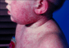 State Reports First Measles Cases of 2026