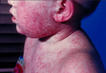 State Reports First Measles Cases of 2026